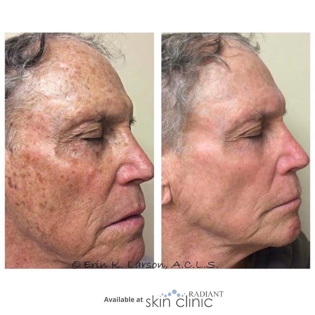 IPL - Radiant Resized