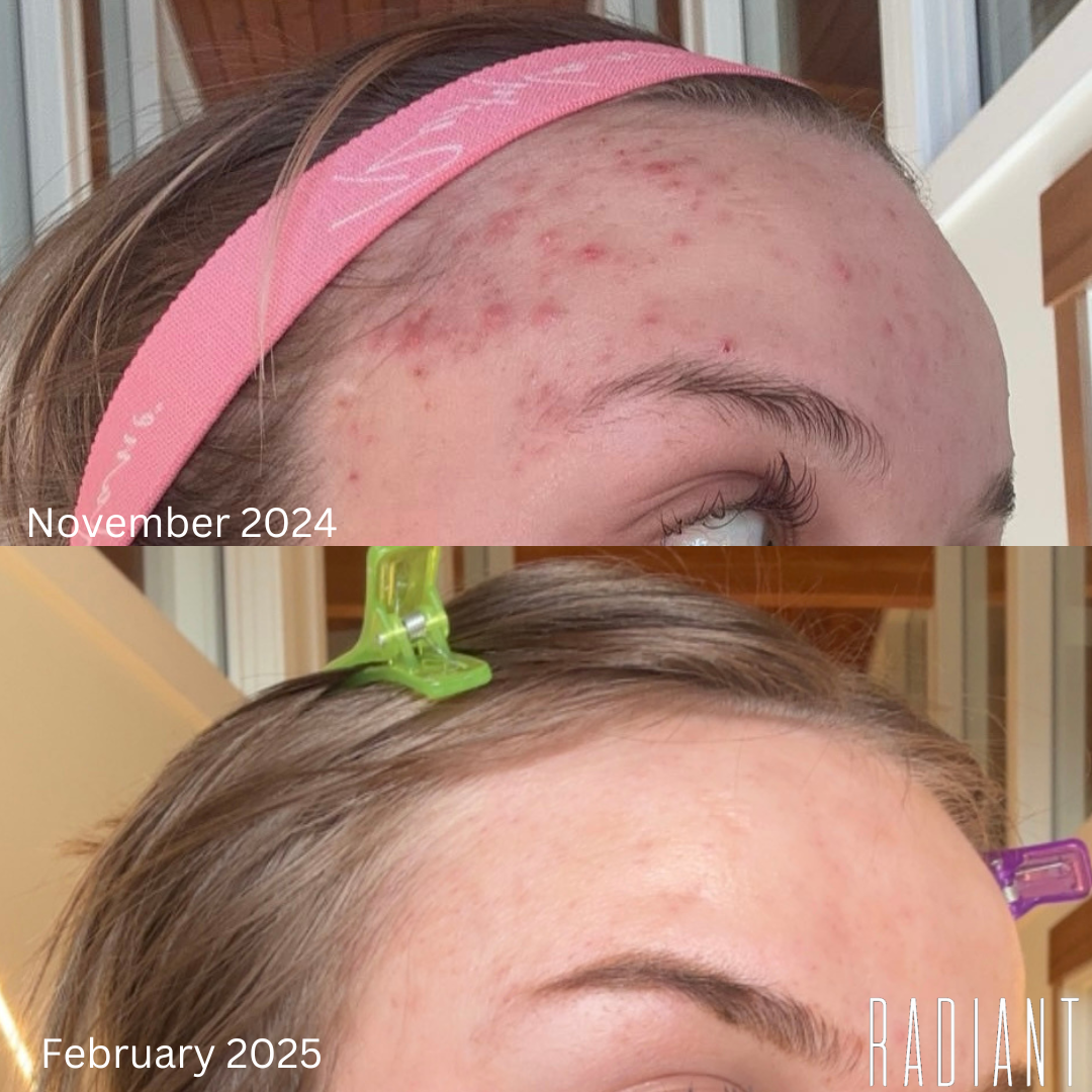 acne Reflection in the mirror. Woman looks in the mirror noticing the first wrinkles