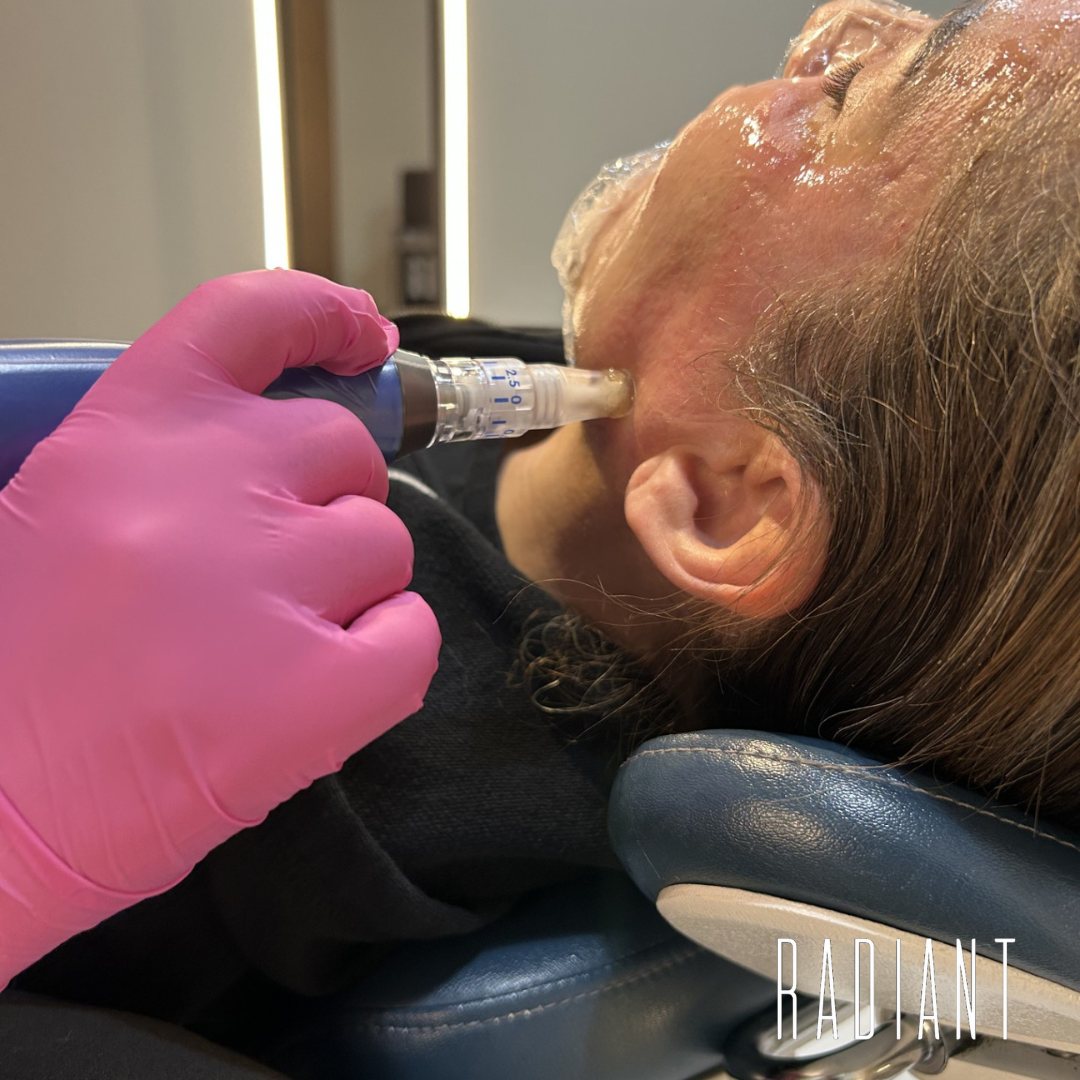 skinpen2